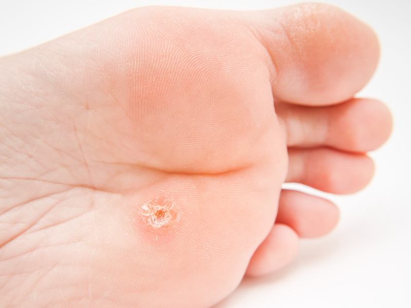 Person With Callus Located Under Foot, Close To Toes Towards White