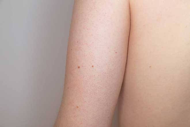 Røde Knopper På Lår & Arme – Keratosis Pilaris