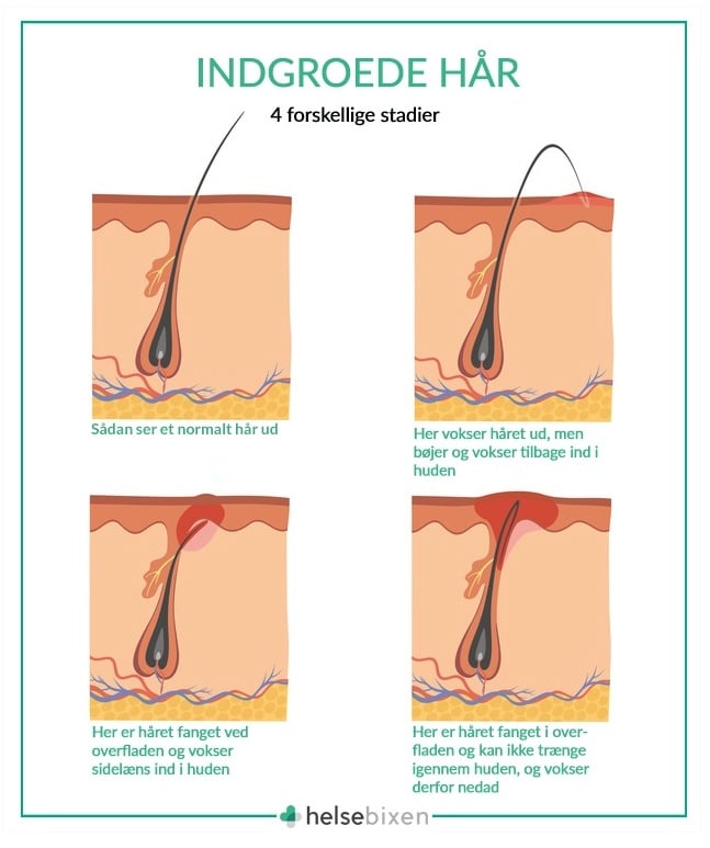 Indgroede Hår Sådan Undgår Behandler Du Dem Helsebixen
